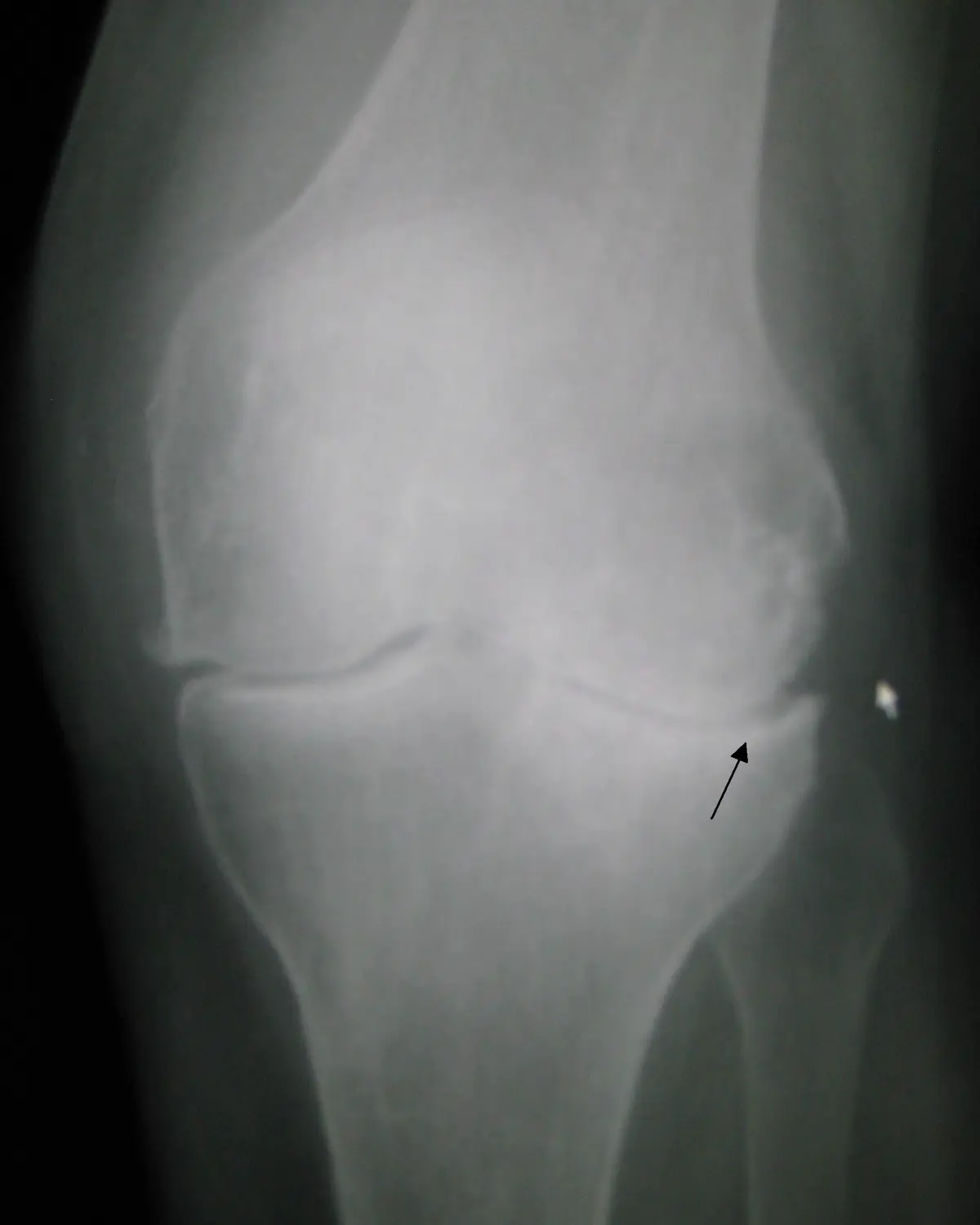 Frontal knee X-ray demonstrating osteoarthritis with tibiofemoral joint-space narrowing, osteophytes and increased subchondral bone density