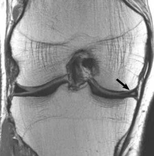 Proton-density coronal MRI of a knee showing a grade 2 medial meniscal tear, with an arrow identifying the abnormal meniscal signal