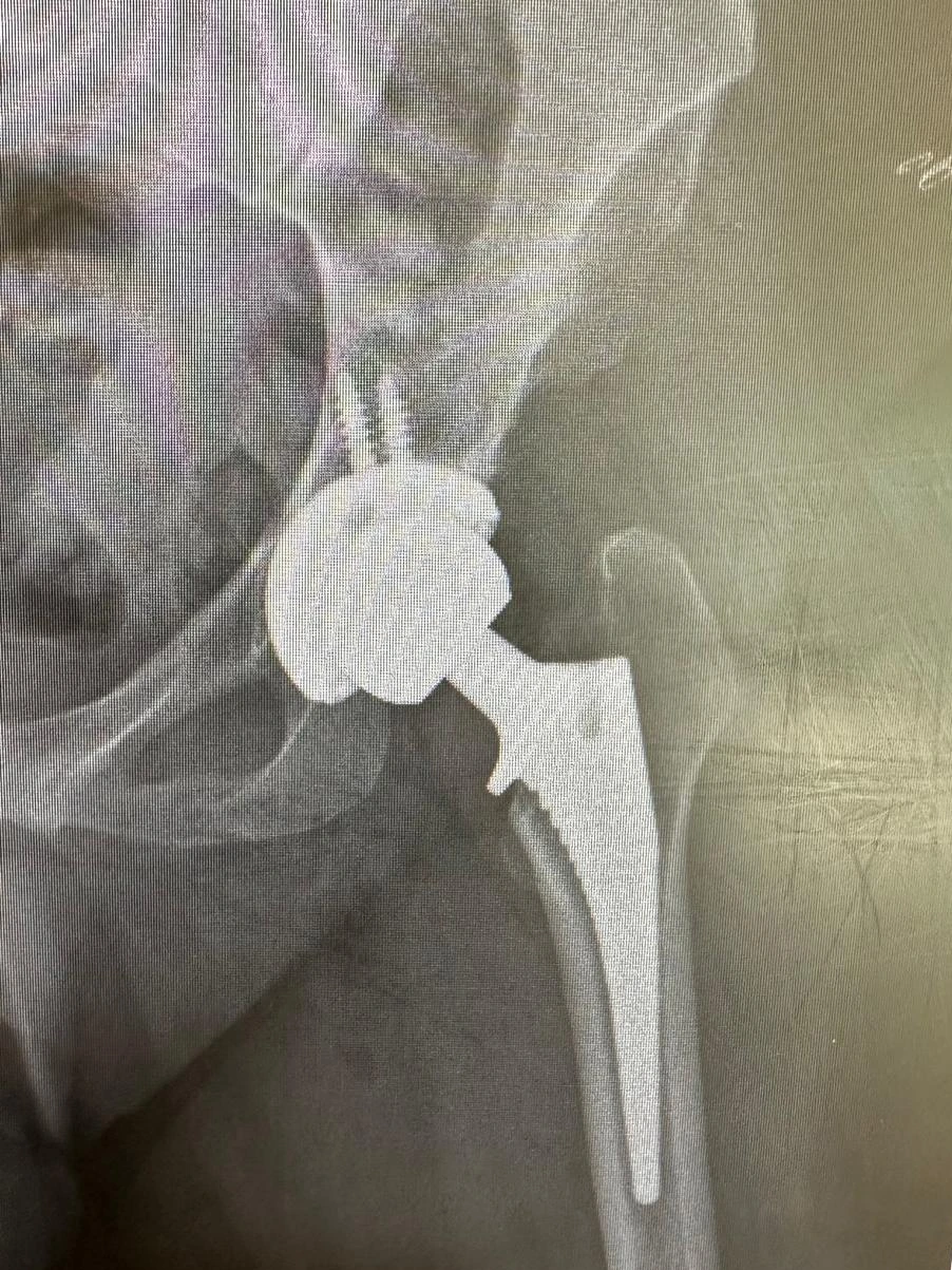 Postoperative X-ray showing an existing total hip replacement