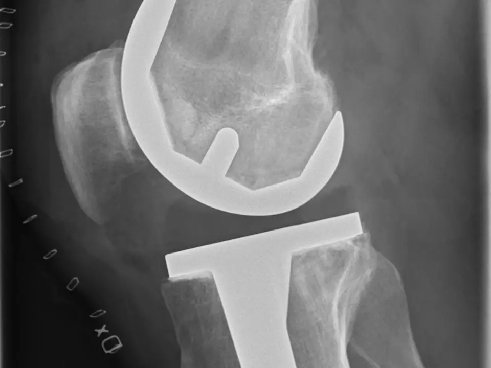 Lateral X-ray view of an existing total knee replacement