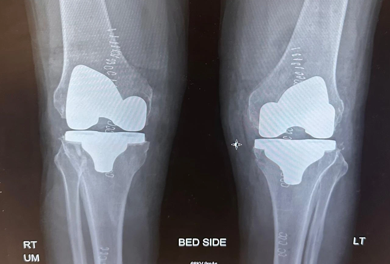 Postoperative X-ray showing existing total knee replacement components