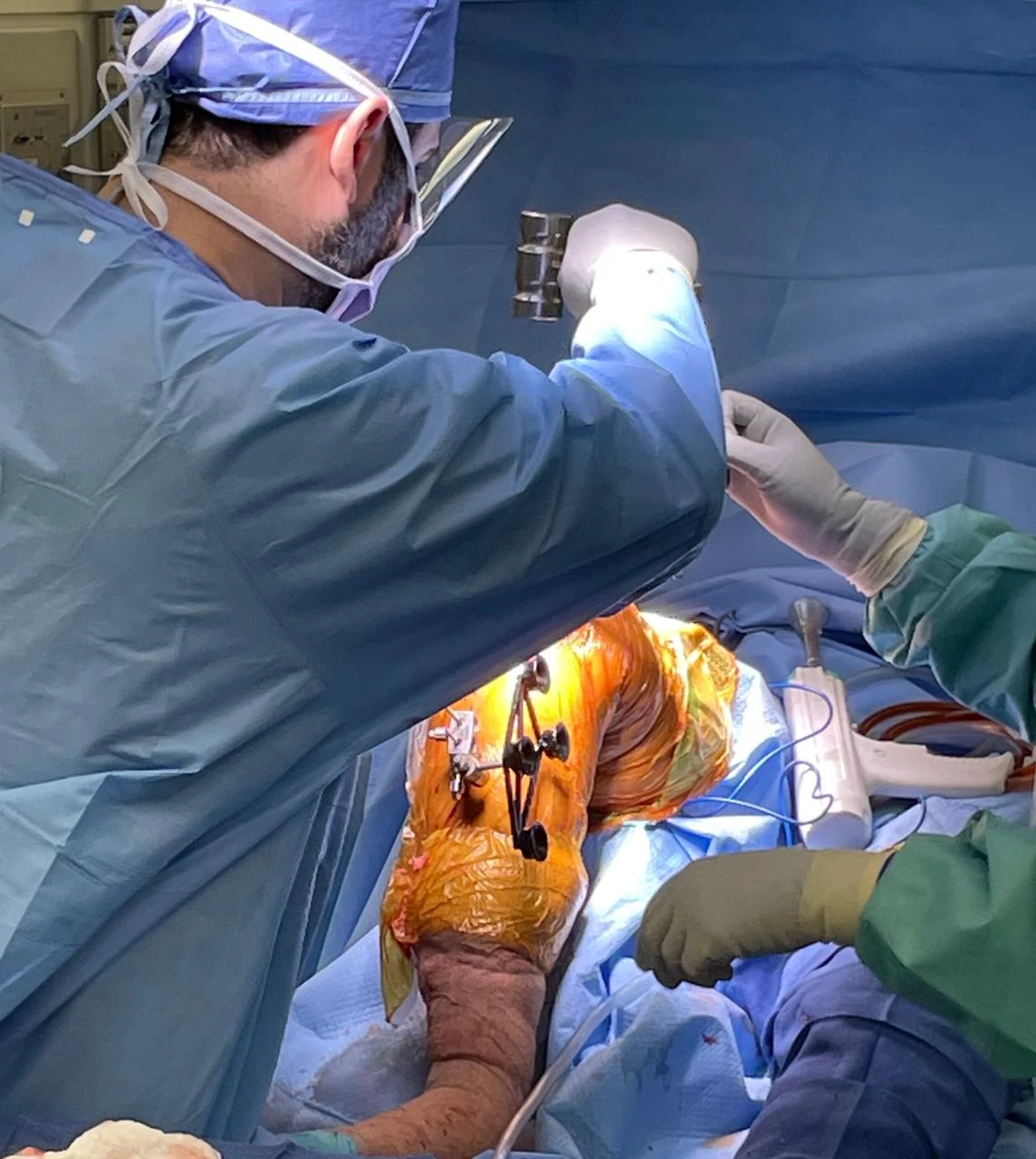 Prof. Dr. Sammy Hanna performing robotic-assisted knee replacement with navigation tracking