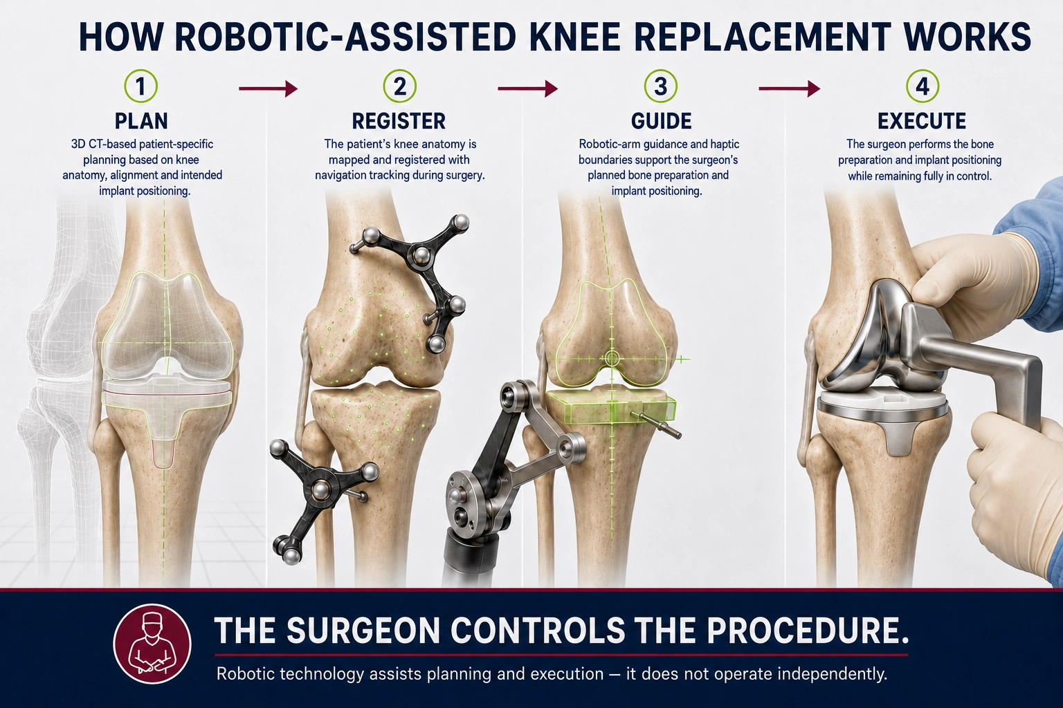 Four-stage robotic-assisted knee replacement workflow: CT-based plan, intra-operative registration, robotic-arm guidance and surgeon-controlled execution